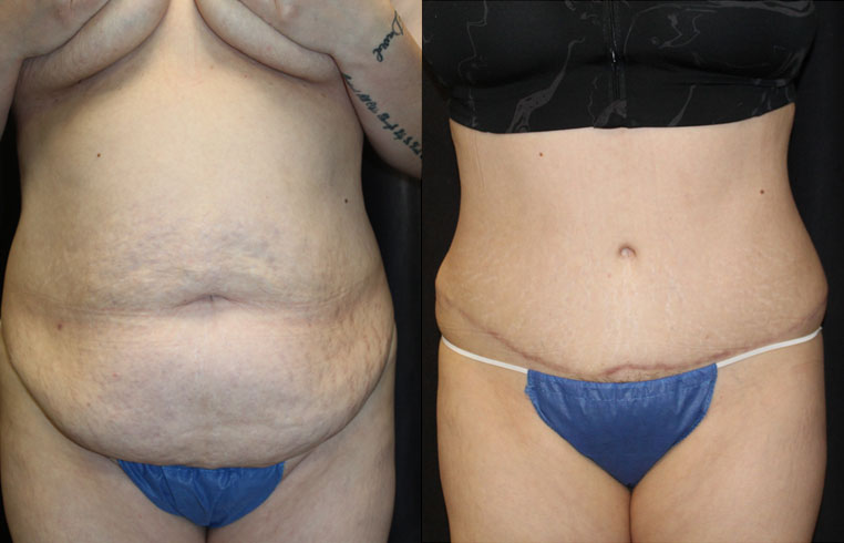 Traumatic hernia with internal evisceration. Repair of hernia with removal of excess tissue.