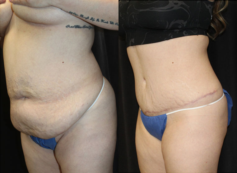 Traumatic hernia with internal evisceration. Repair of hernia with removal of excess tissue.