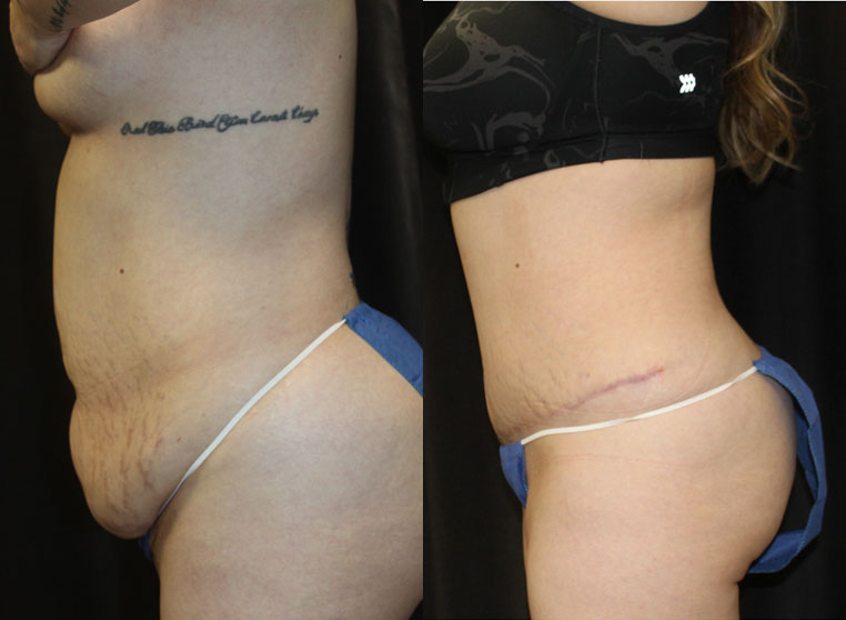 Traumatic hernia with internal evisceration. Repair of hernia with removal of excess tissue.