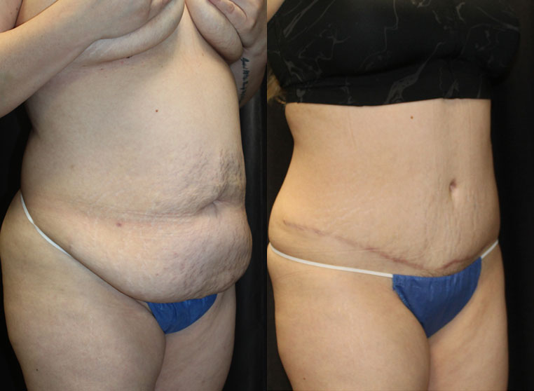 Traumatic hernia with internal evisceration. Repair of hernia with removal of excess tissue.