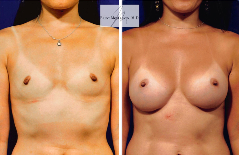 Breast Augmentation with 375cc Saline Implants Subpectoral Placement