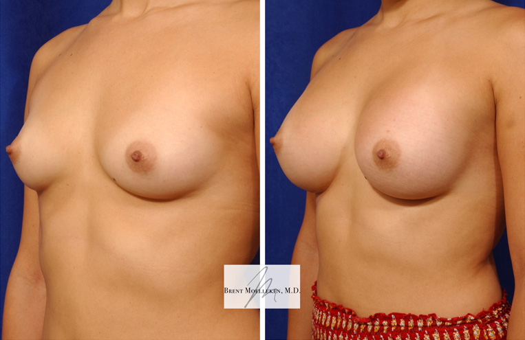 Breast Augmentation with 330 cc Silicone Implants