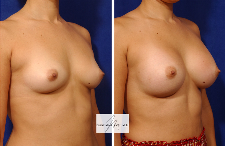 Breast Augmentation with 330 cc Silicone Implants