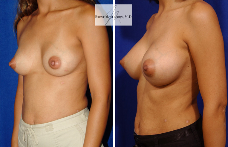 Breast Augmentation Before And After Patient 15 Case 4079 Side View