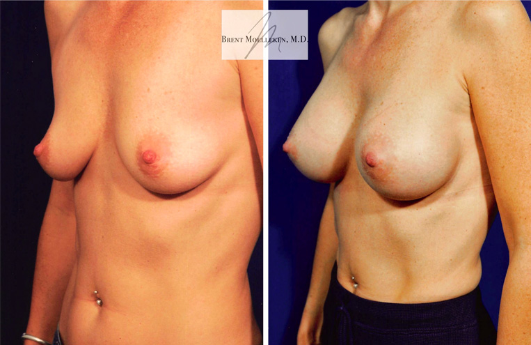 Breast Augmentation Before And After Patient 16 Case 4080 Front View