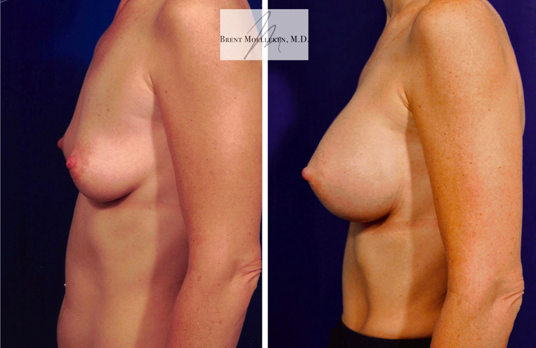 Breast Augmentation Before And After Patient 16 Case 4080 Side View