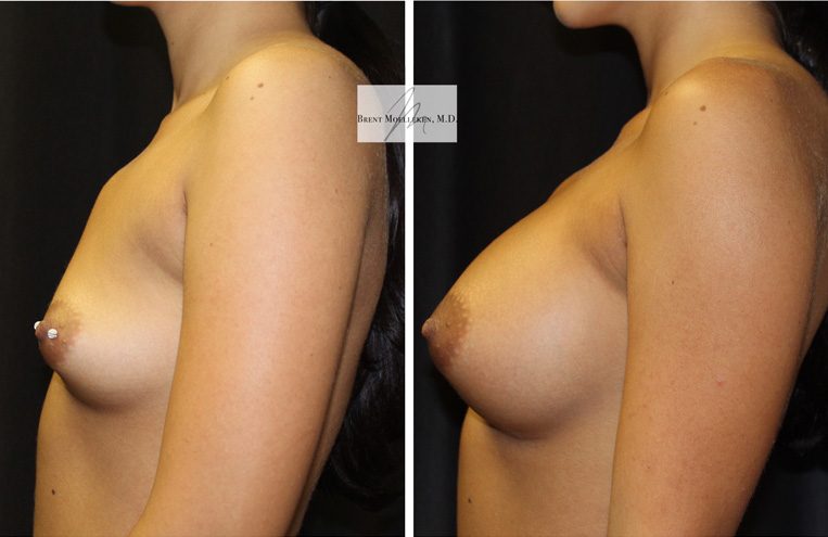 Breast Augmentation 310cc Silicone Implants