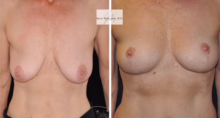 Breast Lift Before And After Patient 1 Case 5209 Front View