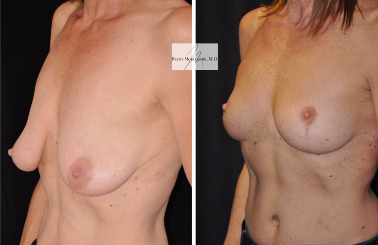 Breast Lift Before And After Patient 1 Case 5209 Right Side View