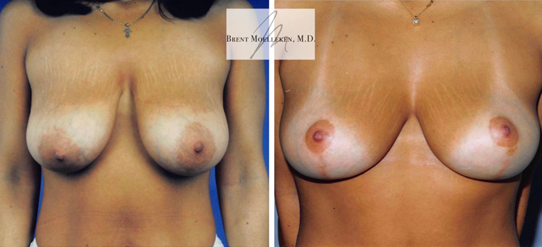 Breast Lift Before And After Patient 5 Case 4133 Front View