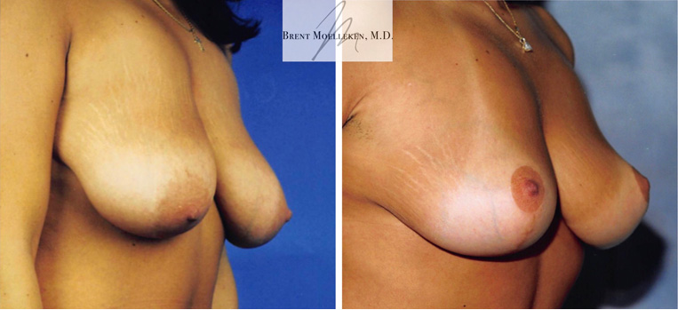 Breast Lift Before And After Patient 5 Case 4133 Side View