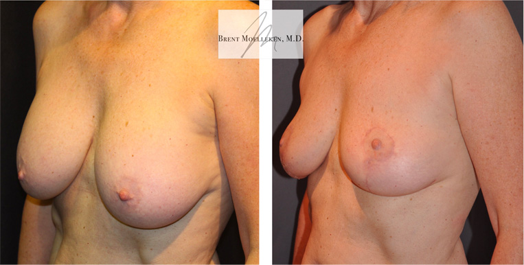 Breast Reduction with Mastopexy