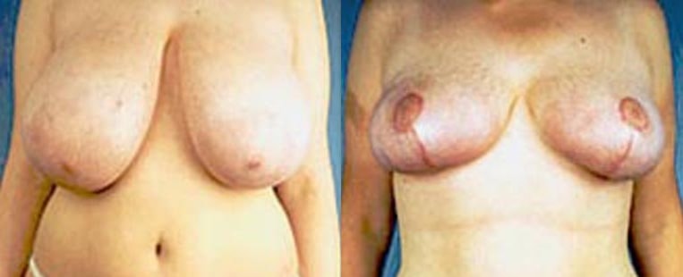 Breast Reduction Before And After Patient 3 Case 4183 Front View