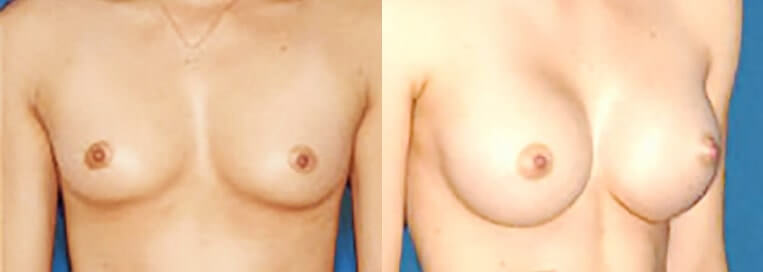 Before and after Breast Augmentation with 390 cc Smooth Saline-Implants inflated to 400cc (Inframammary Incision)