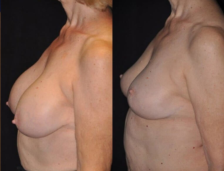Removal of breast implants, breast lift