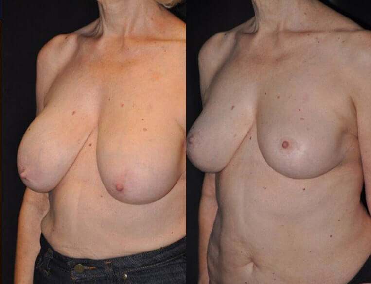 Removal of breast implants, breast lift