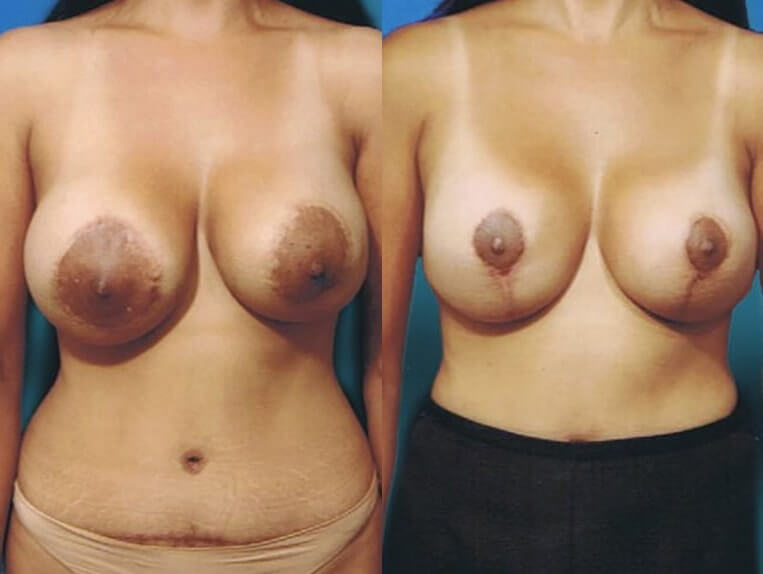 Conversion Benilli to Wise pattern lift, removal of 475cc saline implants and replaced with silicone implants, size 360cc right, 240cc left – 3 months post-op