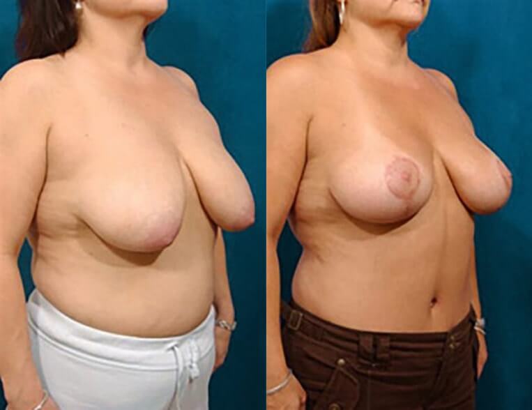 Breast lift – 3 months post-op