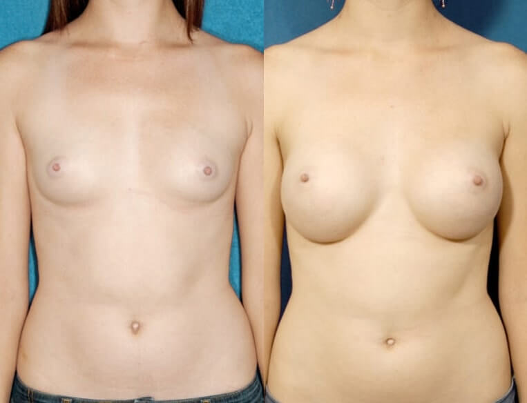 Breast augmentation with smooth saline implants, size 390cc, inflated to 400cc – inframammary incision