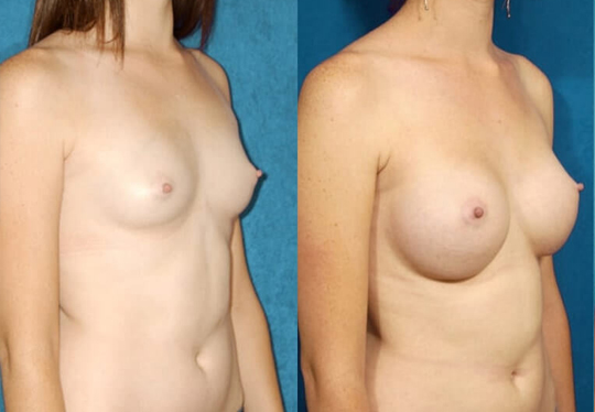 Breast augmentation with smooth saline implants, size 390cc, inflated to 400cc – inframammary incision