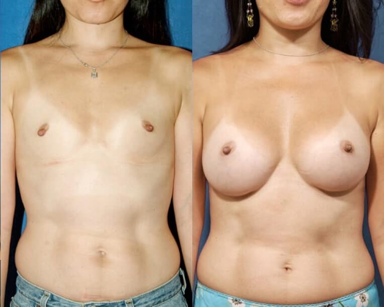 Breast augmentation with smooth saline implants, size 360cc, inflated to 375cc submuscular placement/inframammary incision