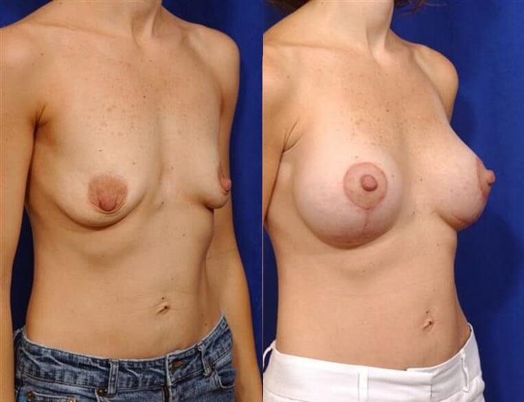 Breast Lift with augmentation