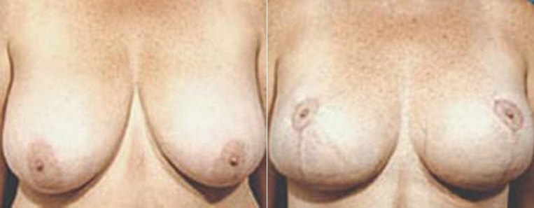 Breast reduction with lift