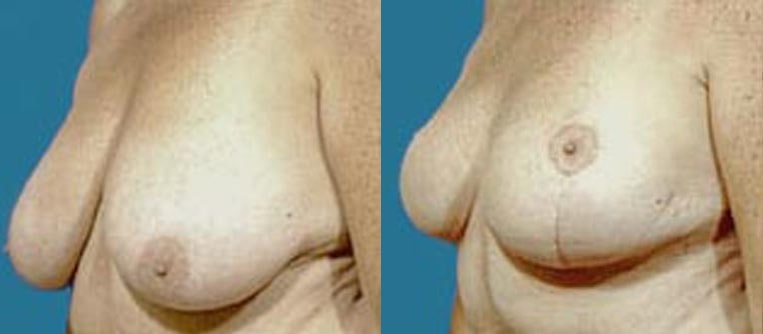Breast reduction with lift