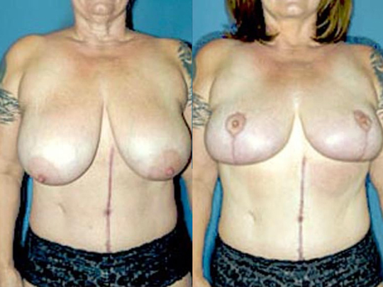 Breast Reduction Before And After Patient 2 Case 4177 Front View