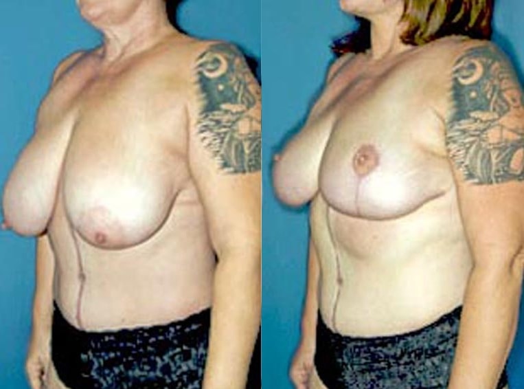 Breast Reduction Before And After Patient 2 Case 4177 Left View