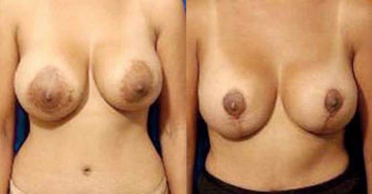 Conversion Benilli to Wise pattern lift, removal of 475cc saline implants and replaced with silicone implants, size 360cc right, 240cc left – 3 months post-op