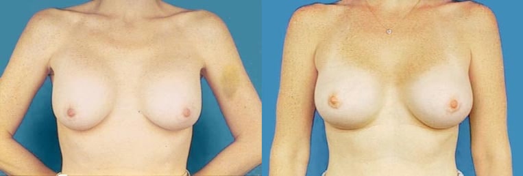 Revision to implant placed above the muscle and nipple asymmetry