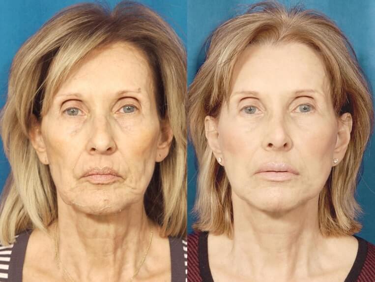 Brow Lift Before And After Patient 3 Case 3313 Front View