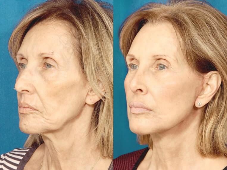 Brow Lift Before And After Patient 3 Case 3313 3/4th Left View