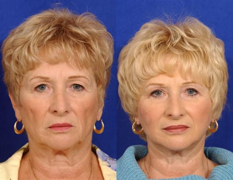 Cheeklift Before And After Patient 2 Case 3353 Front View
