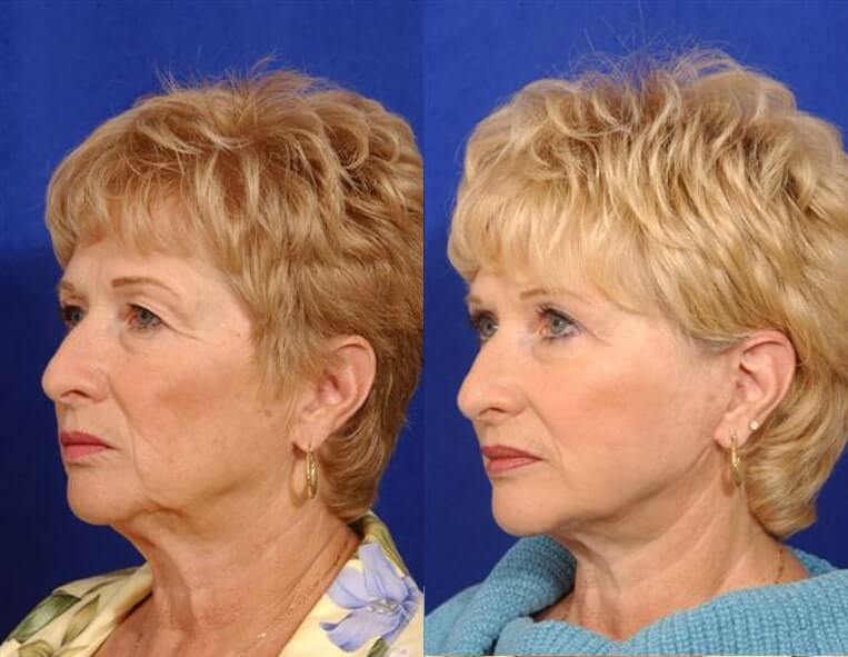 Cheeklift Before And After Patient 2 Case 3353 Left View