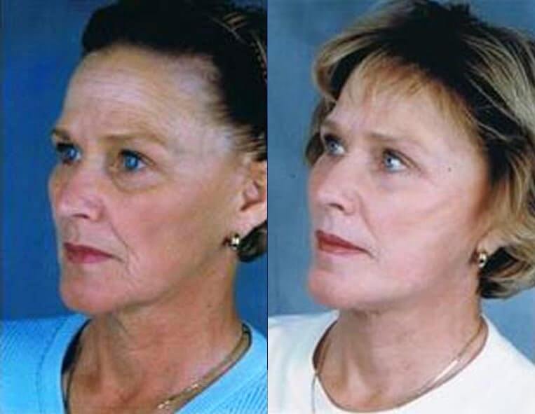 Cheeklift Before And After Patient 3 Case 3359 Left View