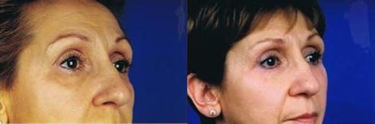 Cheeklift Before And After Patient 4 Case 3363 Right View