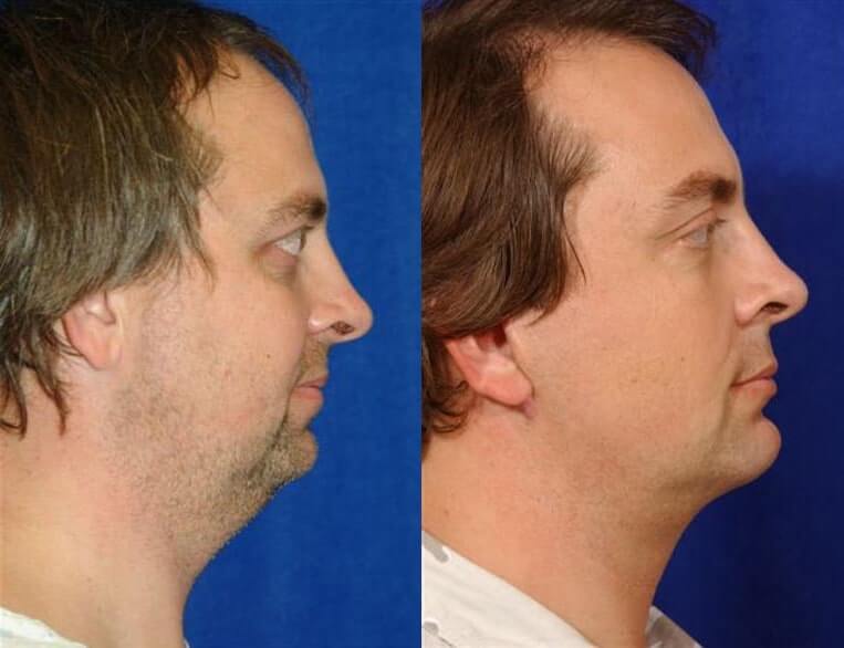 Cheeklift Before And After Patient 5 Case 3367 Right View