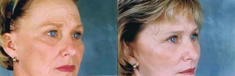 Cheeklift Before And After Patient 7 Case 3377 Right View