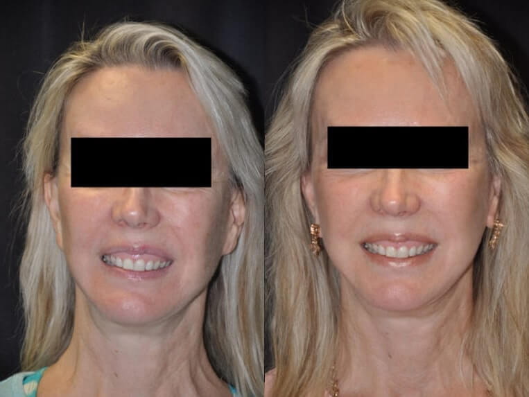 Cheeklift Before And After Patient 8 Case 3381 Front View