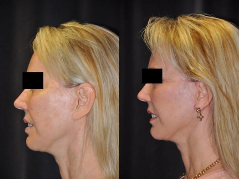 Cheeklift Before And After Patient 8 Case 3381 Left View