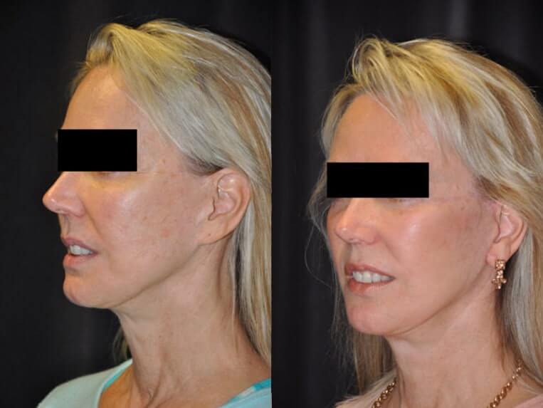 Cheeklift Before And After Patient 8 Case 3381 3/4th Left View