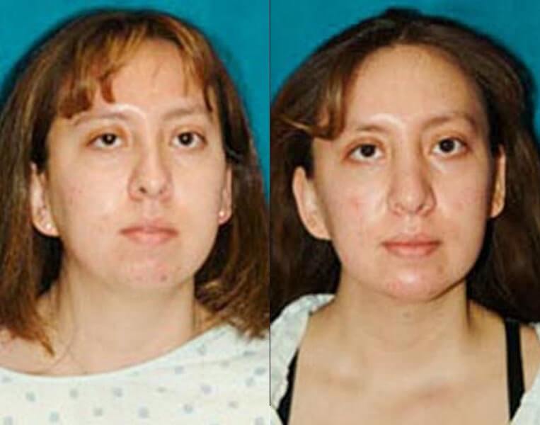 Chin Implants Before And After Patient 1 Case 3393 Front View