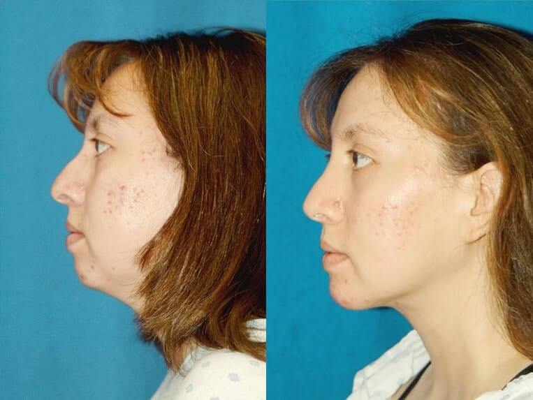 Chin Implants Before And After Patient 1 Case 3393 Left View
