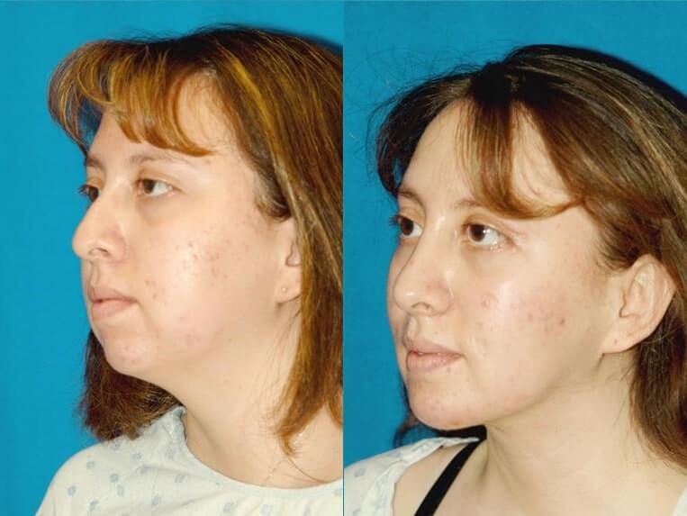 Chin Implants Before And After Patient 1 Case 3393 3/4th Left View