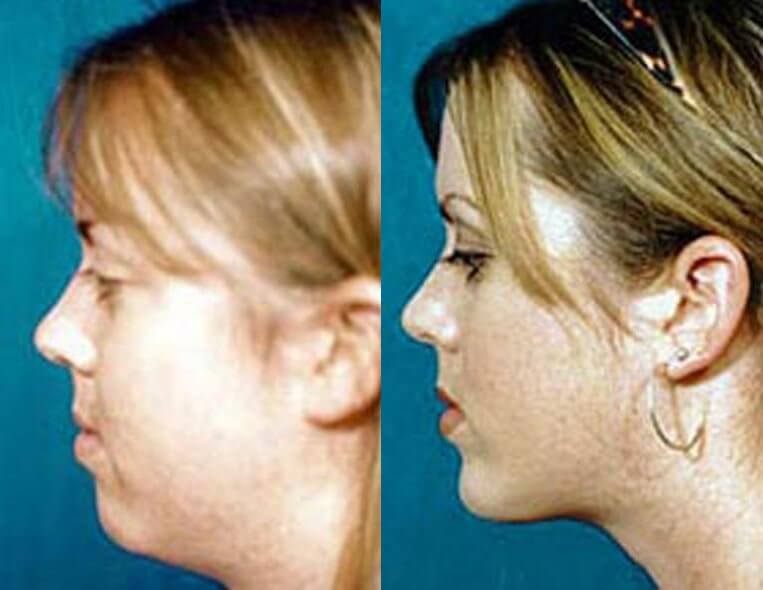 Chin Implants Before And After Patient 2 Case 3401 Left View