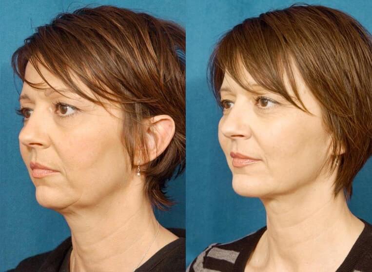 Chin Implants Before And After Patient 3 Case 3407 3/4th Left View