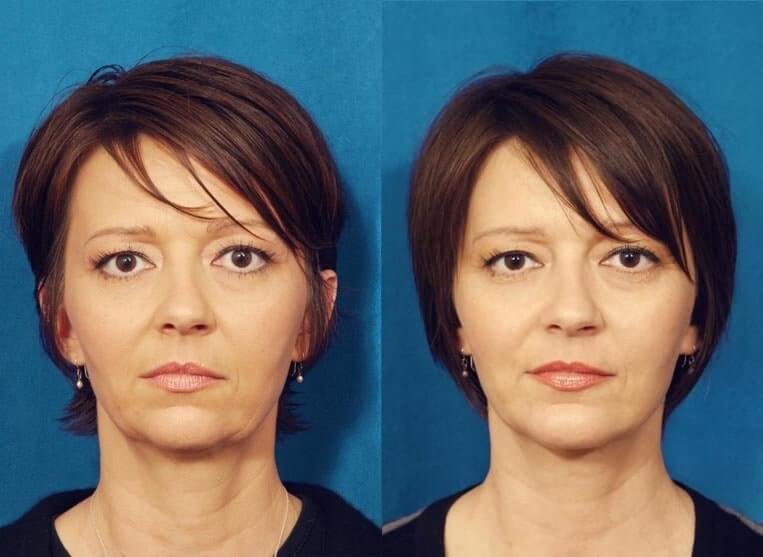 Chin Implants Before And After Patient 3 Case 3407 Front View