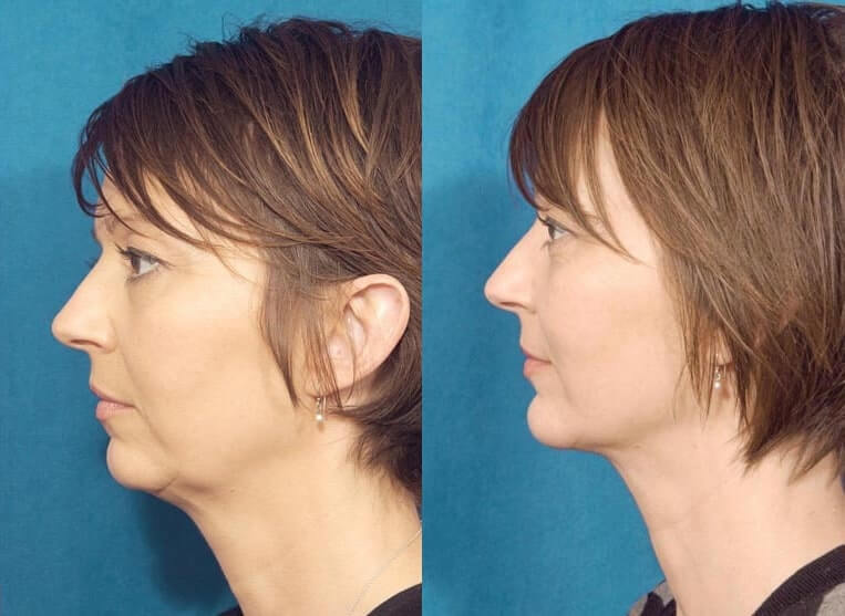 Chin Implants Before And After Patient 3 Case 3407 Left View